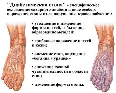 диабет диабет