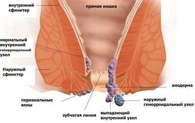 геморрой геморрой