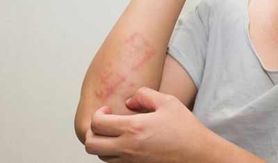 Симптомы псориаза и псориатического артрита купируются бариатрической хирургией