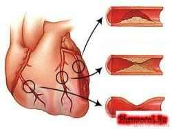 Эффект мини-инсульта может сократить продолжительность жизни Эффект мини-инсульта может сократить продолжительность жизни