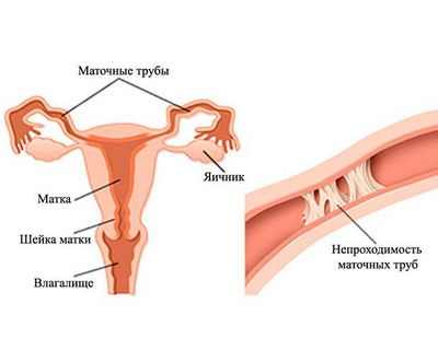 Женщины могут зачать ребенка после опухолей яичников