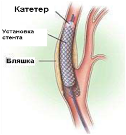 Стентирование сонной артерии - экономически эффективная альтернатива эндартерэктомии