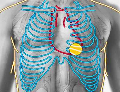 Бивентрикулярная кардиостимуляция разочаровала в исследовании BIOPACE