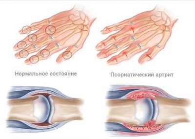 Симптомы опорно-двигательного аппарата предсказывают псориатический артрит