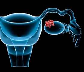 Вторичная операция не улучшает общую выживаемость пациентов с рецидивирующим раком яичников