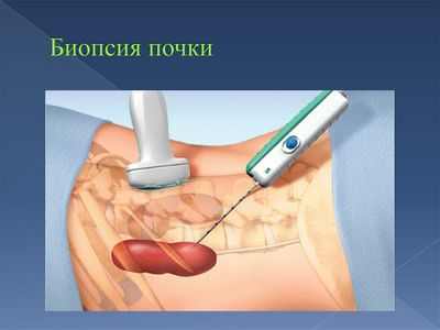 Биопсия перед трансплантацией не определяет успех донорской почки Биопсия перед трансплантацией не определяет успех донорской почки
