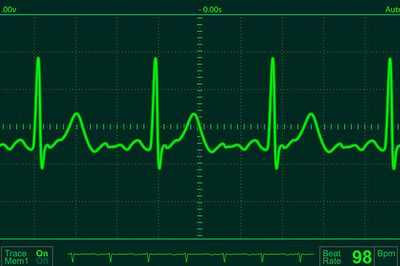 Обнаружен ген, вызывающий фибрилляцию предсердий