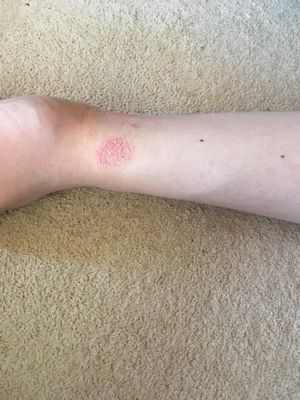 Когда-то считавшееся редким, кожное зудящее дерматологическое заболевание встречается чаще, чем предполагалось Когда-то считавшееся редким, кожное зудящее дерматологическое заболевание встречается чаще, чем предполагалось