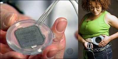 Устройство, блокирующее сигналы желудочного нерва, перспективно при ожирении