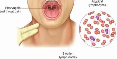 Вирус Эпштейна-Барра и рак: новые уловки от старой собаки