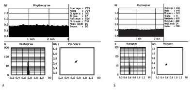 Отмечено снижение вариабельности сердечного ритма во время приливов